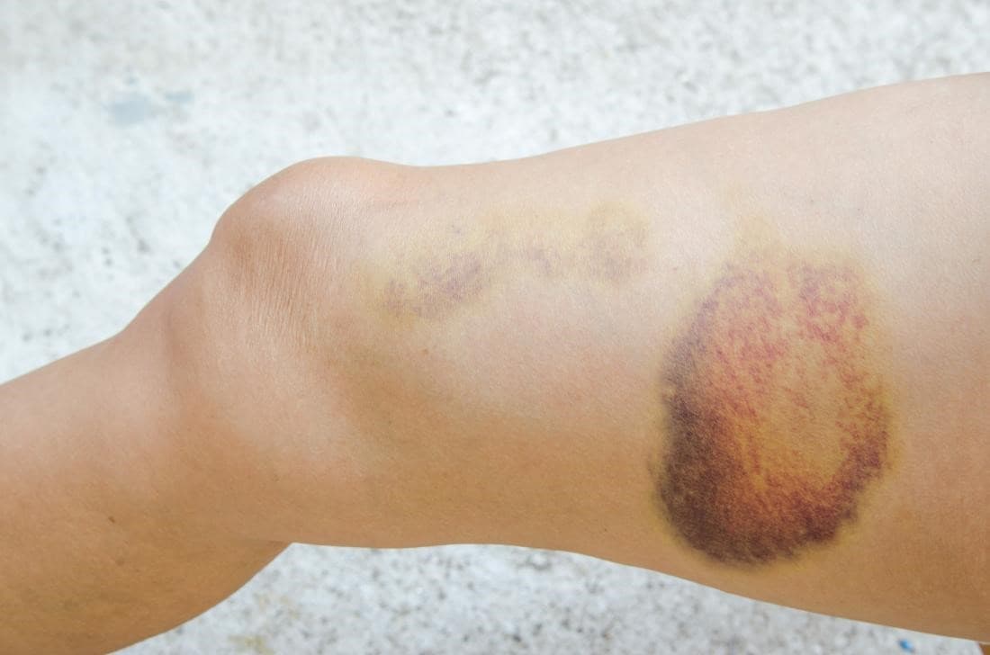 Ādas hematomas diagnostika Dzeltenīgi violeta hematoma uz kājas pie ceļa – zilumu un asinsizplūduma piemērs uz ādas.